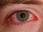 Προσοχή στις αλλεργίες, συνιστούν οι οφθαλμίατροι