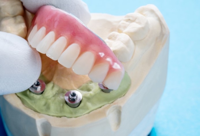 Εμφυτεύματα δοντιών -  Κατηγορίες και σχήματα